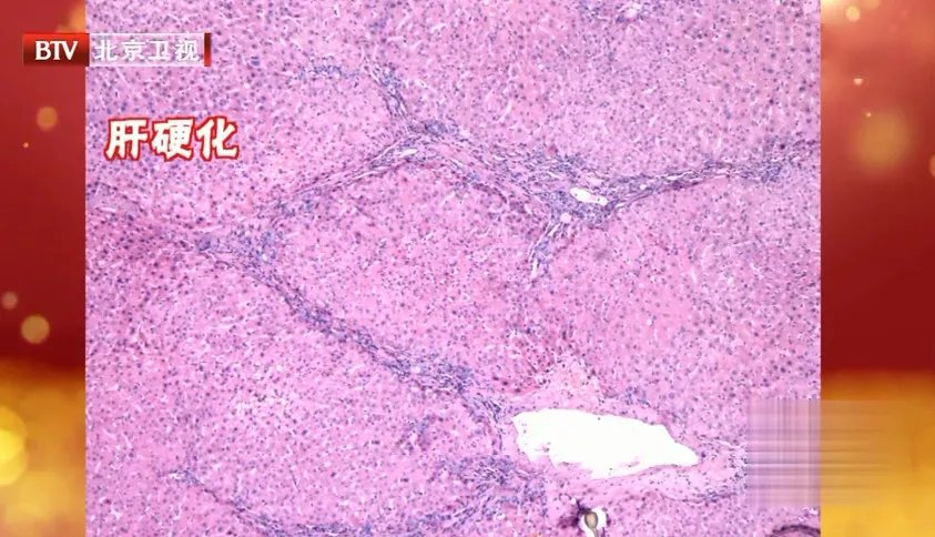 茶多酚|得了脂肪肝,全身都受累,4大癌症风险骤增,还伤血管!这份“逆转方法”请收好~