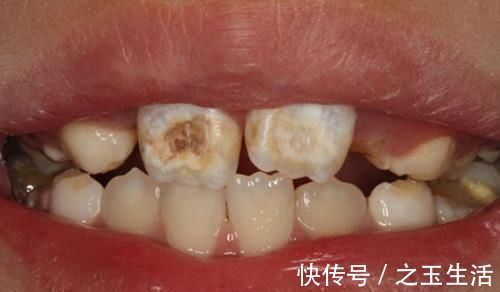 乳牙|让孩子“满嘴烂牙”的不是糖,而是“这1物”,每个人家里都有