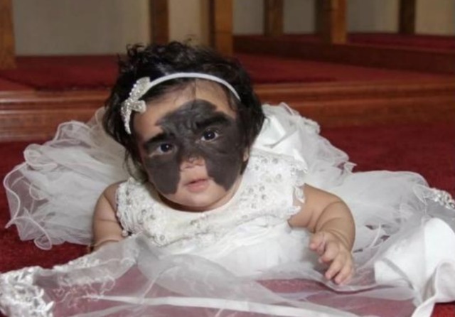 父母|女孩出生就带有“蝙蝠胎记”,做过7次整形手术,现在怎么样了