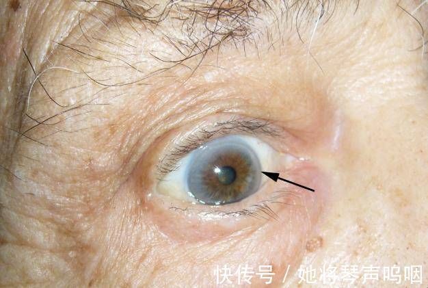 血栓|眼睛有三个信号,是血脂已高,防血栓,做好“戒三物,远四习”!