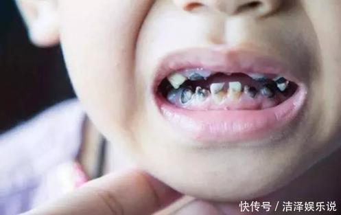 女儿|6岁女儿却满口“小黑牙”,专家:和吃糖没关系,是父母的无知