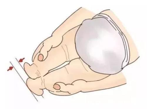 宝宝|宝宝腿纹不对称跟髋关节发育不良有什么关系,3种情况要注意