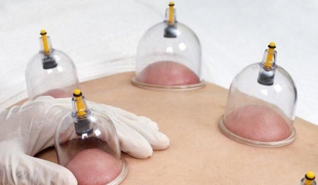 免疫细胞|年轻小伙拔罐治颈椎病,反把右肺吸没?中医:3类人不该拔罐