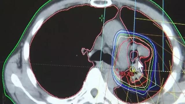 放疗|左肺被肿瘤堵死缩成一团，放疗后吐出一块“鱼肉”，肺瞬间充满