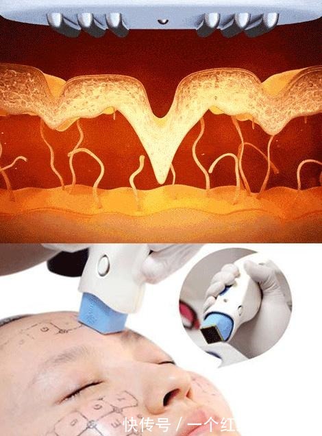 后遗症 拉皮手术“落伍”了,早都“过时”了!