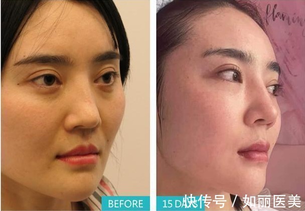 人中 人中长=很显老?“人中缩短手术”可以做吗?