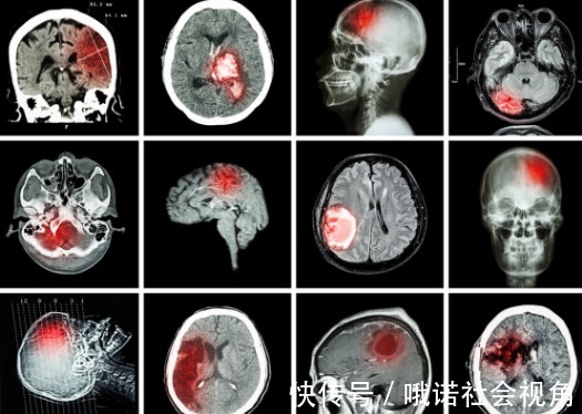 陈可冀|为何脑梗逐年增多?提醒:厨房菜籽油或是"祸首",劝你趁早忌口