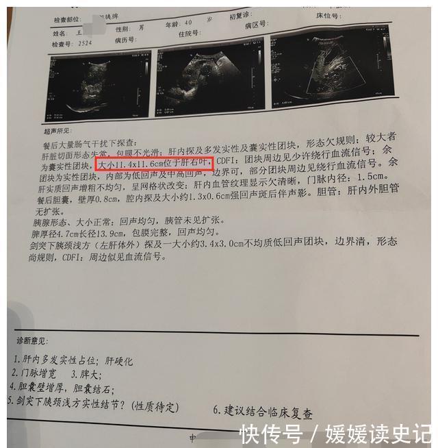 治疗|多方治疗无果的患者,加入中药后,肿瘤缩小一半