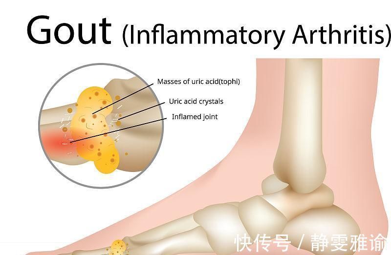 秘诀|真正降尿酸的四个秘诀，多喝水排在第二位，排在首位的你很少坚持