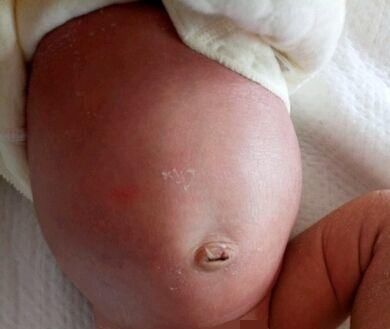 怀孕|6个月女宝肚子胀得像怀孕,家人赶紧送医院,医生:还好来得及时