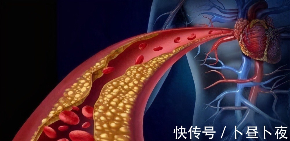 医生|高血压不吃药,如何降血压?医生告诉你这6个方法,简单又实用