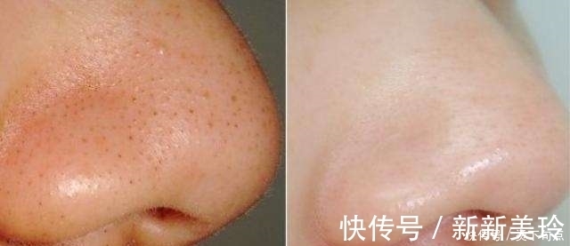 痘痘|“盐水”洗脸原来有这么多好处,不知道的人吃亏啦