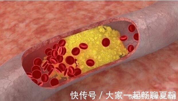 患者|血管变硬时,身体会有4“怪象”!占一个,也要引起重视