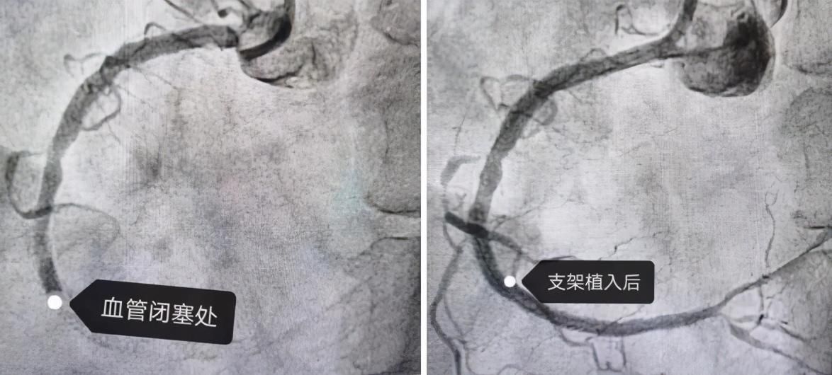 沈阳市第一人民医院：装了支架就一劳永逸？错！