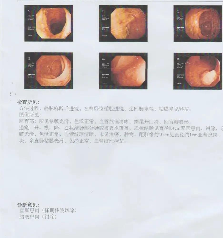 基因检测|粪便基因检测精准查出管状绒毛状腺瘤,将肠癌扼杀在萌芽阶段