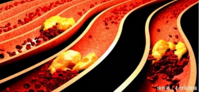 血脂|多走路可以降血脂?心血管医生:过了50岁,做好3件事更有效果