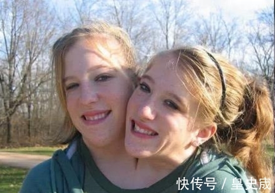 去世|“连体人”中一人不幸去世,另一人会怎么样?看完算是明白了