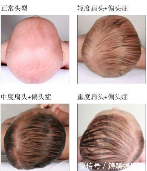 头型|孩子“头型”暗示了未来“身高”家长别不信,这种头型矮不了