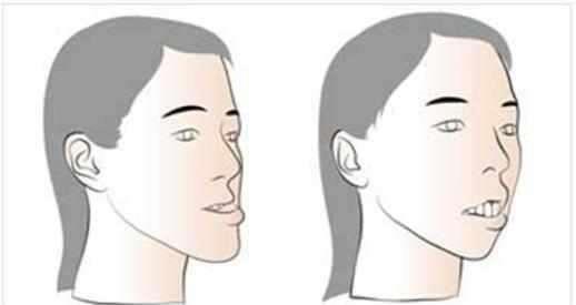 牙齿矫正|儿童做牙齿矫正三个最佳时间:家长要牢记,矫治越早干预效果越好