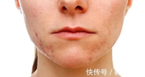 妇科疾病|女人有妇科病都“写”在脸上?脸部这4种情况,若没中,值得庆幸