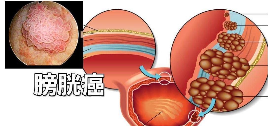  情况|血尿大多数情况都是小问题，但是这种情况一定要重视！可能很严重