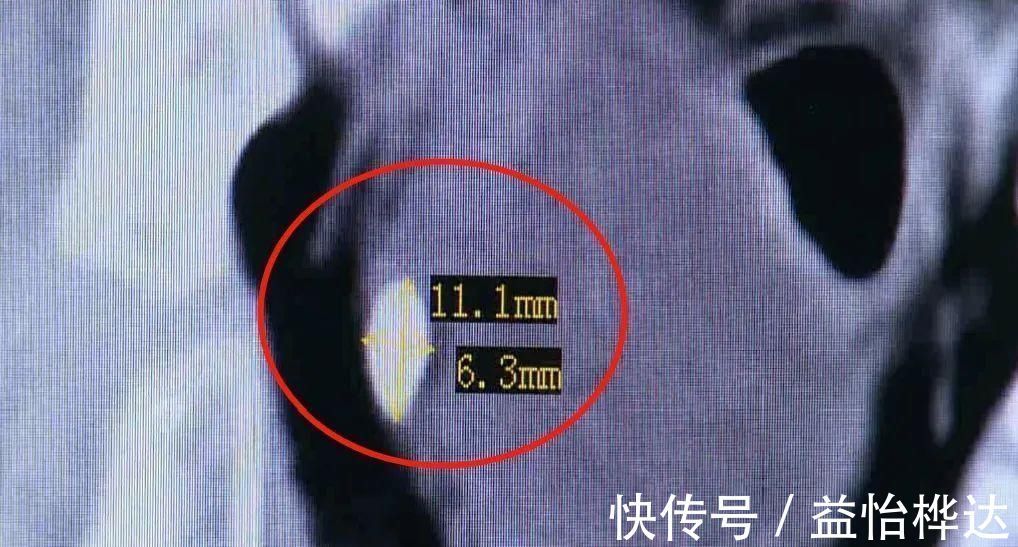 爸妈|5岁女童患尿路结石…送医时已发烧、抽搐、呼吸困难爸妈注意了