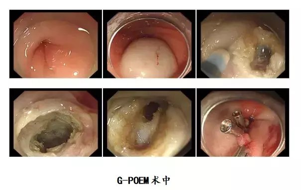 黏膜|经口内镜下幽门切开术，为胃轻瘫患者辟新径
