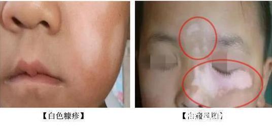 补锌|儿童缺锌高发季已来临!过来人传经:四个信号,暗示该给娃补锌了