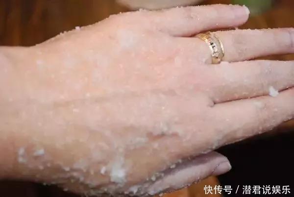 冬天手、耳朵、脚、腿又干又粗糙只需3步,让你皮肤又白又嫩