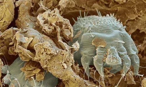 排螨|后背总能抠下一粒粒的东西？那就说明你该排螨了