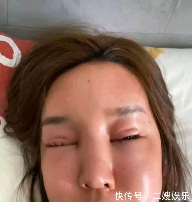 东北女孩 8年的整形手术花费了100多万,光额头就打了200多支玻尿酸