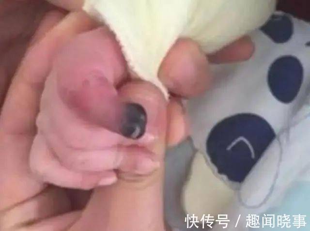 截肢|2个月宝宝险被截肢,每小时放一次血!凶手竟是妈妈一根头发