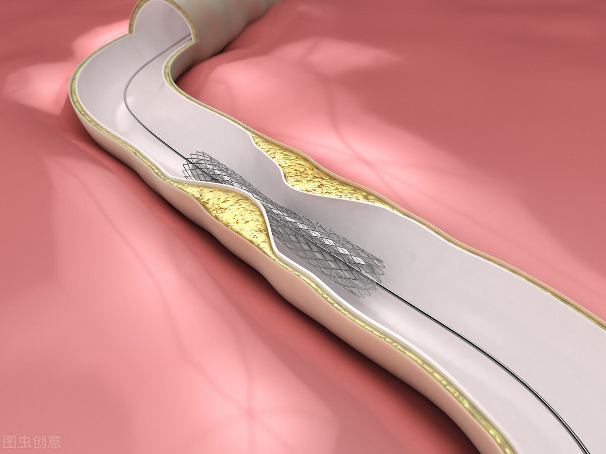 做完心脏支架手术就安枕无忧这6件事要