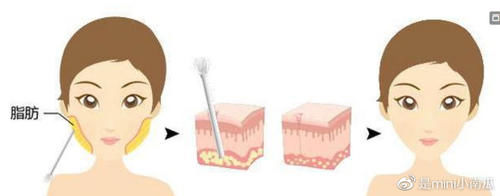 光纤溶脂瘦脸可靠吗？术后多久能看到效果？