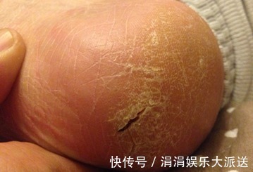 脚后跟|脚后跟的皮肤出现了干裂，不只是皮肤的问题，早知早受益