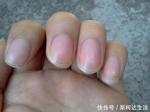 月牙|指甲是人体健康的“晴雨表”，若有这3个表现，或与健康密切相关
