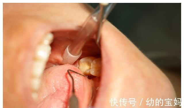 牙龈|孕妈妈得了牙周炎千万不能忍，小心对胎儿有影响