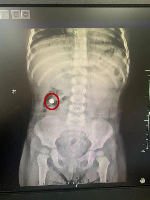 儿科医生|太惊险!大过年的,1岁多宝宝竟误吞了这东西