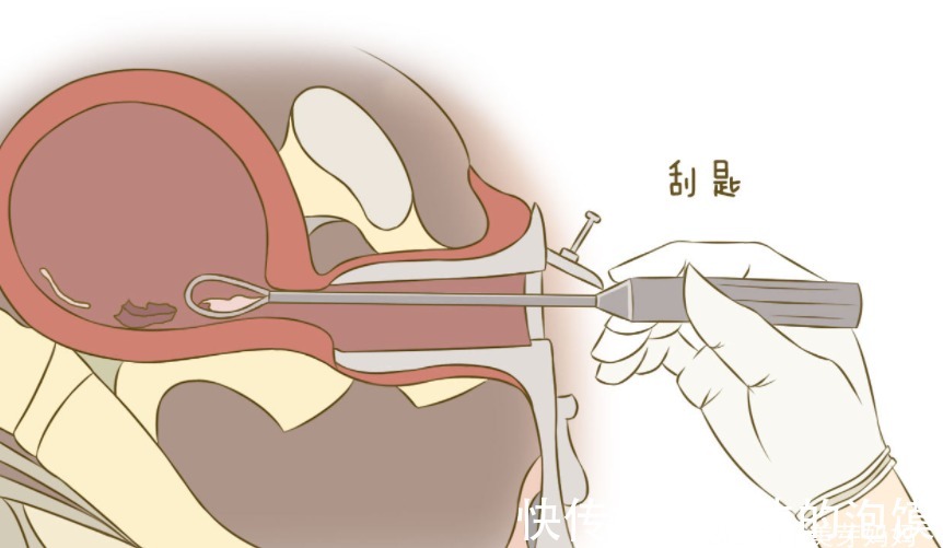 子宫口|女人是否“打过胎”,妇科医生一看便知,嘴上的承诺不牢靠