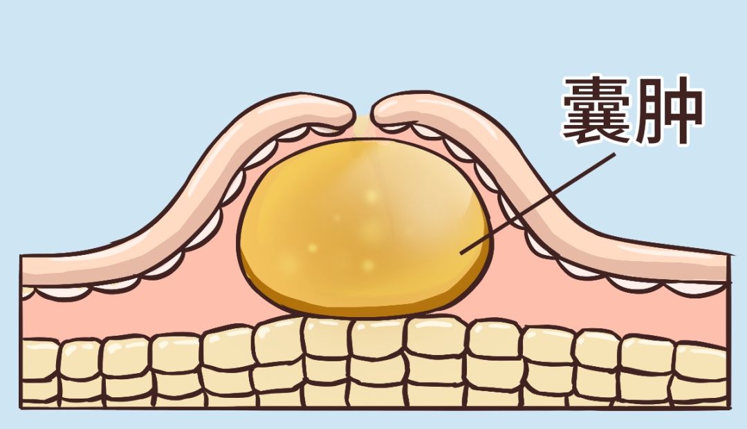 乳腺结节|体检查出结节、囊肿的你，是不是彻夜难眠？