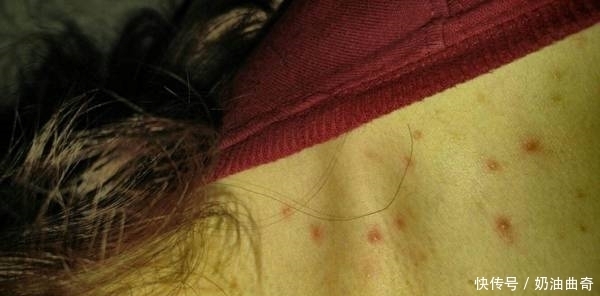 复发|数亿只螨虫爬上身导致背后痘痘频发，3个方法解决，很难复发