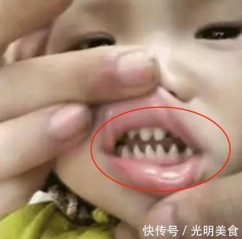 刷牙|“鲨鱼牙”宝宝照片走红，妈妈送医后，医生全赖家长