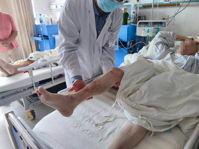 主任|86岁上海老伯晨练摔倒瘫痪在床，到医院一查竟是危险“黑痣”已长进脊髓……