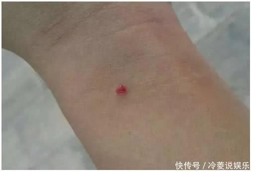 肝功能|不论男女，若手上没有这3个“标志”，恭喜，你的肝脏还很健康！