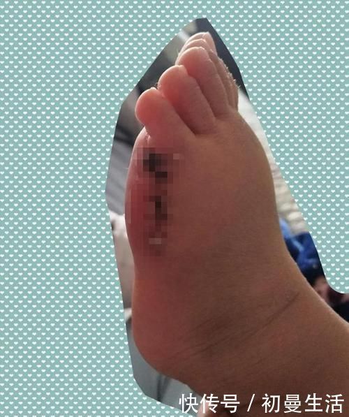 畸形|新生儿出生后有6个脚趾,医生在指尖“绣花”,网友:巧夺天工