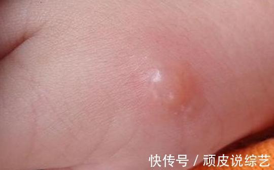 高发季|手足口病高发季已经来临,孩子身上出现这些症状,家长就要警惕