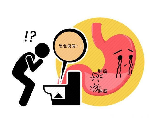 大便|早期的腸癌，癥狀很細微若排便出現這4個現象，那就要當心了