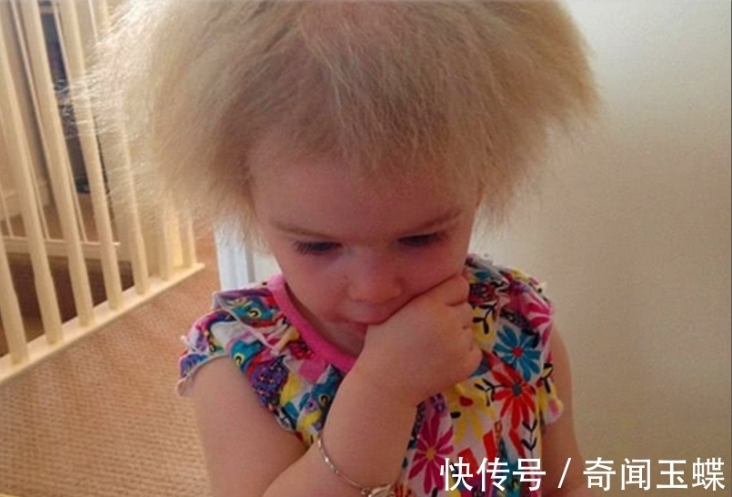 头发|世界上最奇怪的病，患者不能梳头，全球仅有百例，爱因斯坦是其一