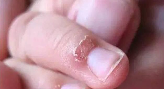 家长|孩子手上经常出现“倒刺”,家长着急,可能是3个原因引起的