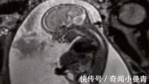 肿瘤|孕妇做产检却被告知肚中有肿瘤, 医生建议立刻动手术, 数月后孩子出生众人傻了眼